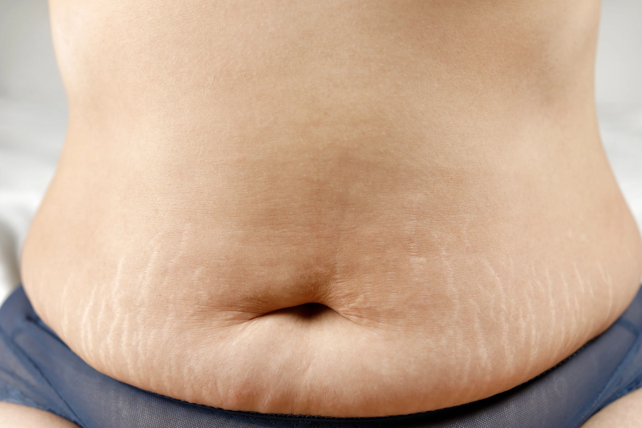 Does Stretch Marks Mean Weight Loss-Ultimate Guide In 2025