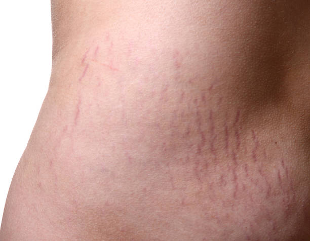 Does Stretch Marks Mean Weight Loss